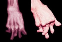 /album/galeria-de-fotos/artritereumatoide1-jpg/